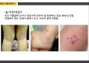 [아동간호학] 농가진 (impetigo).pptx 4페이지