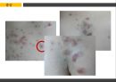 [아동간호학] 농가진 (impetigo).pptx 8페이지