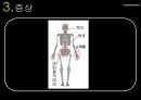 골다공증.ppt 11페이지