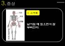 골다공증.ppt 15페이지