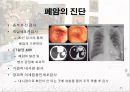 암과 관절염 {간암, 대장암, 위암, 폐암, 유방암}.pptx 44페이지