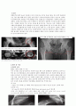 성인 정형외과  되퇴골두 무혈성괴사(ONFH) 간호진단 (컨퍼 완성본) 3페이지