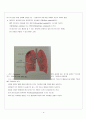 폐결핵 케이스 (Tuberculosis CASE STUDY), 폐결핵 간호진단, 폐결핵 간호과정, TB case TB 케이스스터디, Tuber culosis case study, 폐결핵 간호사정, 폐결핵간호과정 케이스스터디 6페이지