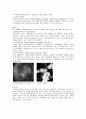 Ascending colon cancer 상행결장암 - 상행결장에 발생하는 악성 종양. 결장암의 98%는 adenocarcinoma이다. 2페이지