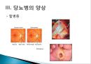 [당뇨병 (diabetes mellitus)] 당뇨병 실체와 원인, 당뇨병 증상, 당뇨병 합병증, 당뇨병 식이요법, 당뇨병 치료법.pptx 7페이지