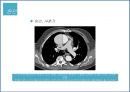 [인간질병과 건강한 삶]치주질환의 정의와 예방법 - 치주질환 개념, 치주질환 원인, 치주질환 사례, 치주질환 예방.pptx 12페이지