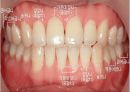 [치주질환 (periodontal disease)] 치주질환 정의, 치주질환 종류, 치주질환 원인, 치주질환 증상, 치주질환 치료.ppt 4페이지