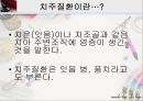 [치주질환 (periodontal disease)] 치주질환 정의, 치주질환 종류, 치주질환 원인, 치주질환 증상, 치주질환 치료.ppt 12페이지