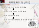 [치주질환 (periodontal disease)] 치주질환 정의, 치주질환 종류, 치주질환 원인, 치주질환 증상, 치주질환 치료.ppt 16페이지