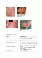 [자가 면역 질환] 자가면역질환의 발생기전 및 조절 기술 - 자가 면역 질환 개념, 자가 면역 질환 연구, Rheumatoid arthritis, Rheumatoid arthritis 치료, 자가 면역질환의 연구과정 11페이지