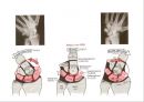 Elbow & Wrist & Finger 팔꿈치 & 손 수술 방법의 이해.pptx 25페이지