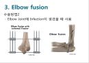 Elbow & Wrist & Finger 팔꿈치 & 손 수술 방법의 이해.pptx 50페이지