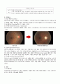 녹내장 케이스 2페이지
