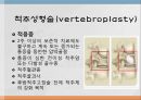 척추 수술 환자 간호(척추압박골절,VP,KP,MBB) 9페이지