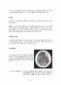 만성경막하출혈케이스 2페이지