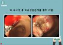 위장관 출혈 GI Bleeding 문헌고찰 정의 병태생리 증상 치료 간호과정 3개 15페이지