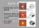 녹내장의 병리와 치료 발표 피피티 12페이지