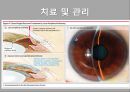녹내장의 병리와 치료 발표 피피티 23페이지