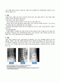 성인간호학 실습 : 정형외과, 척추전방전위증, OS, spondylolisthesis 4페이지