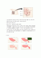 급성충수염(ACUTE APPENDICITIS)케이스 5페이지