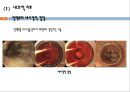 간경변, 간경변치료, 간경변간호, 간경변약물치료, 간경변식이관리, 간경변합병증관리, 문맥성고혈압, 식도정맥류출혈, 복수, 간성뇌병증 11페이지