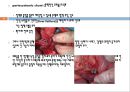 간경변, 간경변치료, 간경변간호, 간경변약물치료, 간경변식이관리, 간경변합병증관리, 문맥성고혈압, 식도정맥류출혈, 복수, 간성뇌병증 13페이지