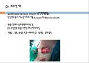 간경변, 간경변치료, 간경변간호, 간경변약물치료, 간경변식이관리, 간경변합병증관리, 문맥성고혈압, 식도정맥류출혈, 복수, 간성뇌병증 16페이지