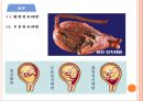 태반조기박리 PPT (사례 및 사정을 바탕으로 개념,분류,증상,진단,치료,간호지침) A+++++ 8페이지