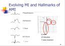 MI환자의 마취 관리 15페이지
