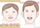 정신지체란,정신장애( 정신분열 병, 양극성정동 장애),발달장애 (지적 장애, 자폐성 장애),정신지체 정도,정신지체 발생분포 17페이지
