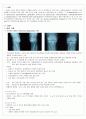 전슬관절치환술 TKR ; total knee replacement 케이스 3페이지