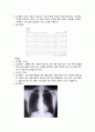 동 기능부전 증후군,sick sinus syndrome 케이스, CASE, case study , 케이스스터디 A+ 6페이지