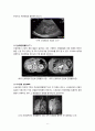 케이스스터디, 신장암 사례연구, 성인간호학 사례연구 6페이지