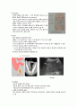 성인간호학) 충수염(Appendicitis) 3페이지