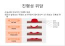 상부소화관 내시경 소견 30페이지