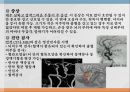 중환자실 case study - SAH(지주막하 출혈) A+자료입니다.  4페이지