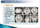 두경부 (Head & Neck) CT 에 관하여 12페이지
