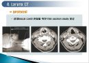 두경부 (Head & Neck) CT 에 관하여 21페이지