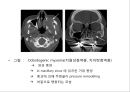두경부 CT에 관한 PPT 자료 39페이지