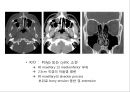 두경부 CT에 관한 PPT 자료 45페이지