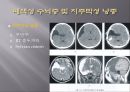 Brain CT에 관한 PPT 5페이지