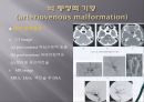 Brain CT에 관한 PPT 12페이지