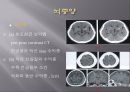 Brain CT에 관한 PPT 25페이지