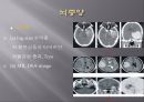 Brain CT에 관한 PPT 26페이지