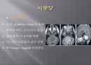Brain CT에 관한 PPT 27페이지