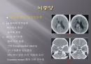 Brain CT에 관한 PPT 28페이지
