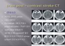 Brain CT에 관한 PPT 43페이지