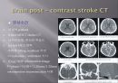 Brain CT에 관한 PPT 44페이지