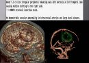 Brain CT에 관한 PPT 49페이지