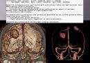 Brain CT에 관한 PPT 50페이지